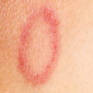 Fungal skin infections commonly misdiagnosed